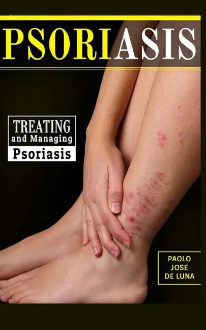 Psoriasis: Treating and Managing Psoriasis - Paperback
